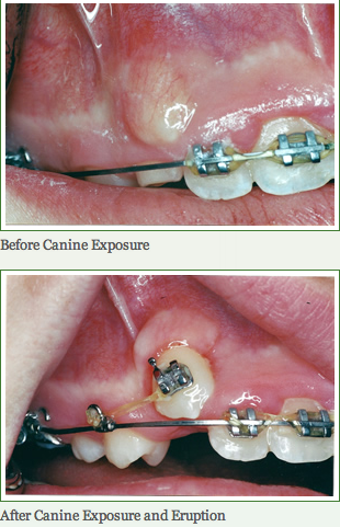 canine exposure and eruption
